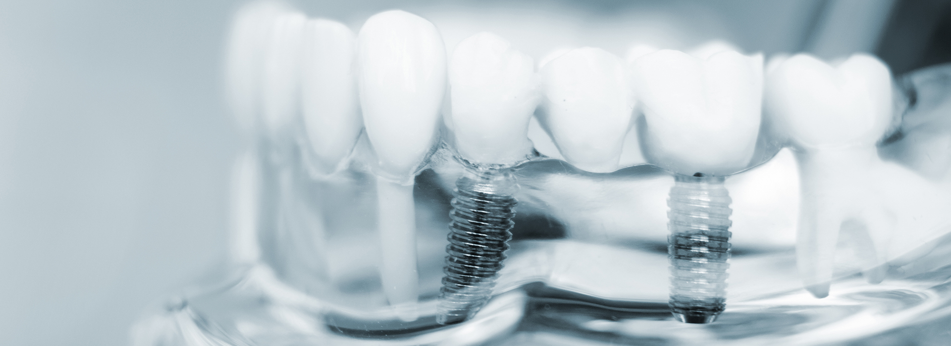 The image shows a close-up view of a dental implant with screws and other components visible against a blurred background, which appears to be part of a dental clinic setting.