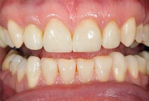 The image shows a close-up of a person s teeth with yellowing enamel, indicating potential dental issues such as staining or decay.