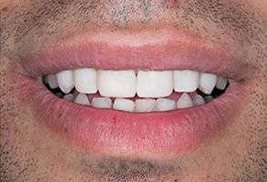 The image shows a close-up photo of a person s smiling mouth with white teeth and a mustache.