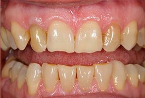 The image shows two photographs side by side of an open mouth with yellowed teeth and visible stains, indicating poor oral hygiene.